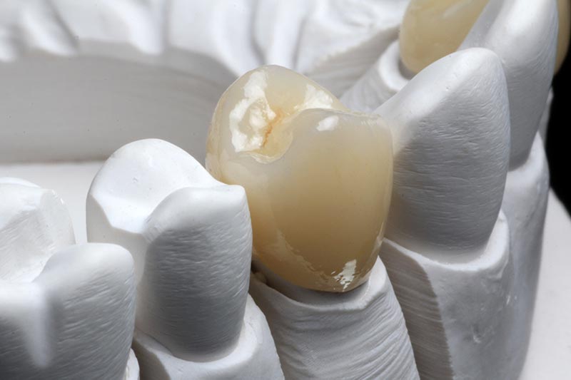 Dental Crown CEREC