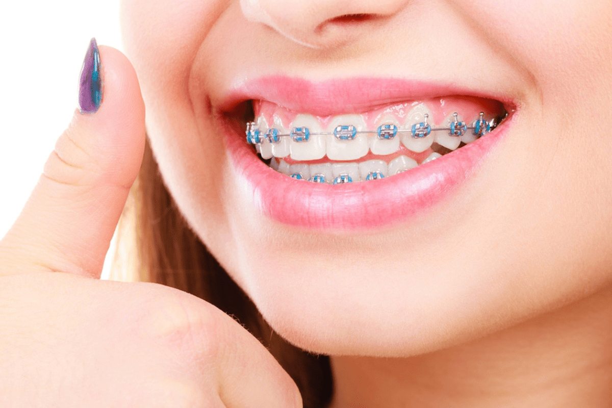 Braces