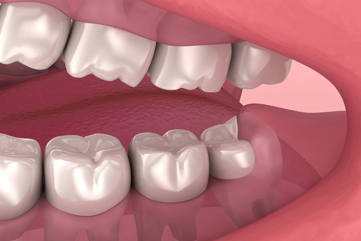 Pericoronitis