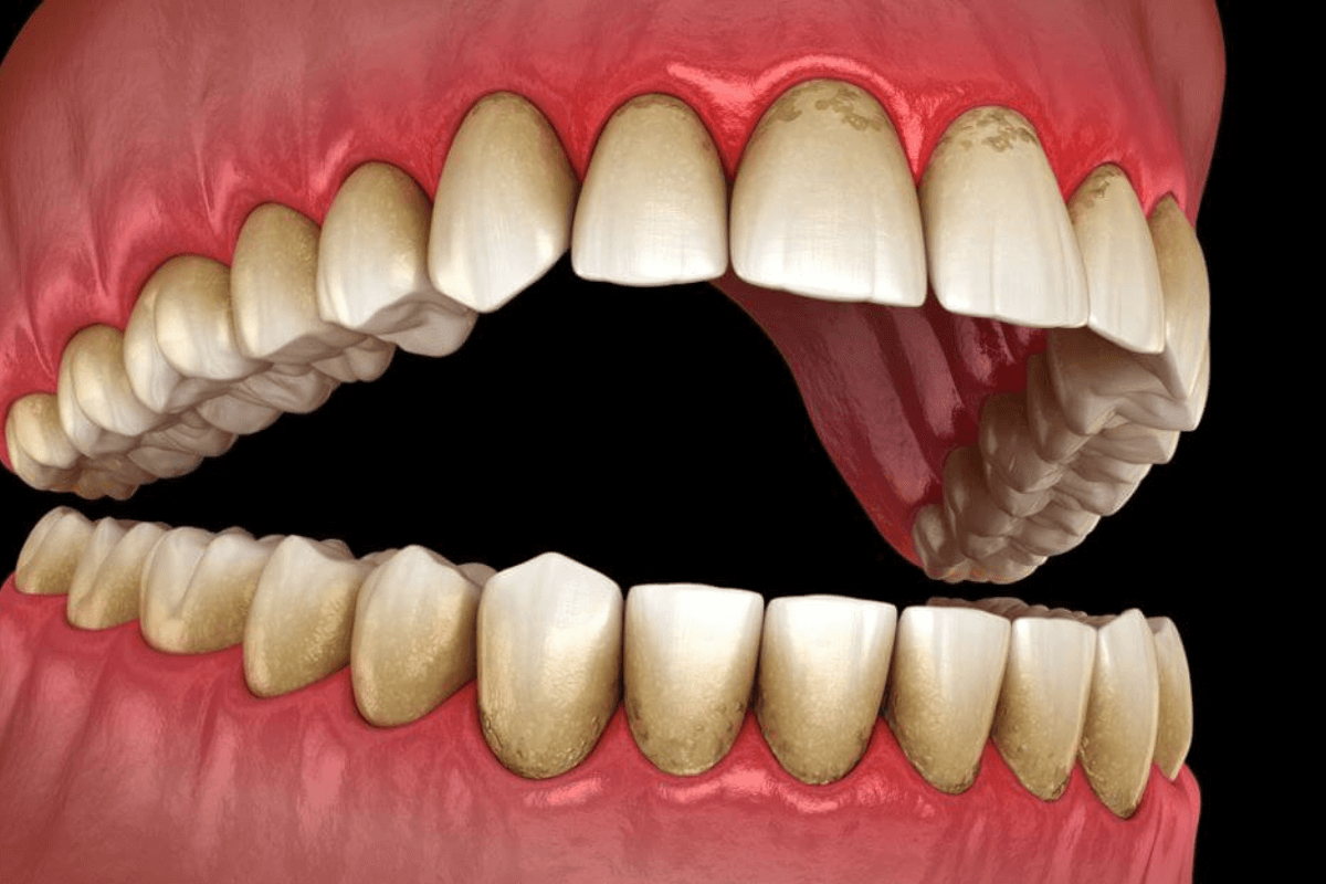 Gum Line Cavities