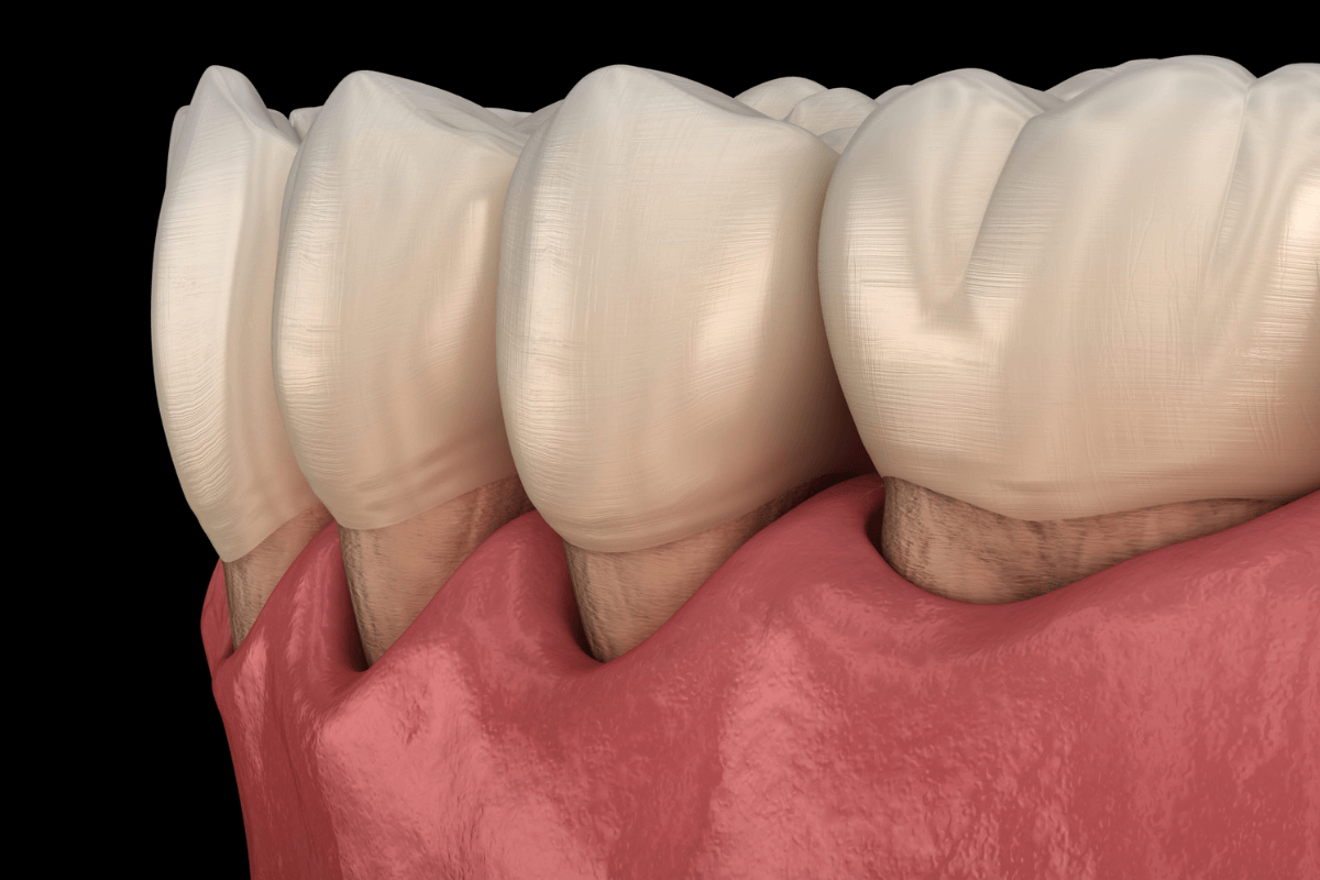 Gum Line Cavities
