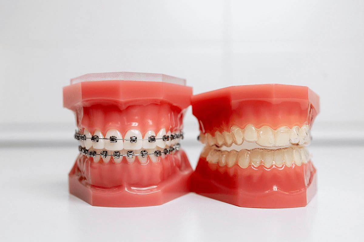 Invisalign Braces