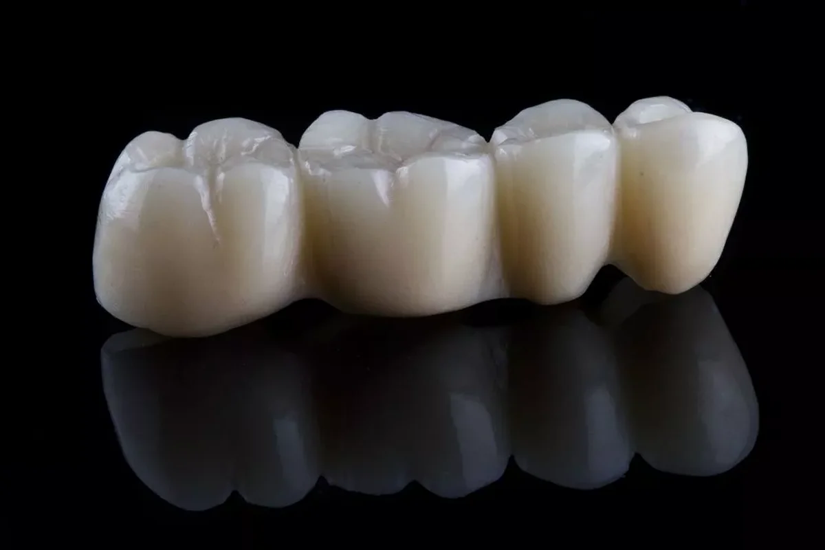 Dental Bridges