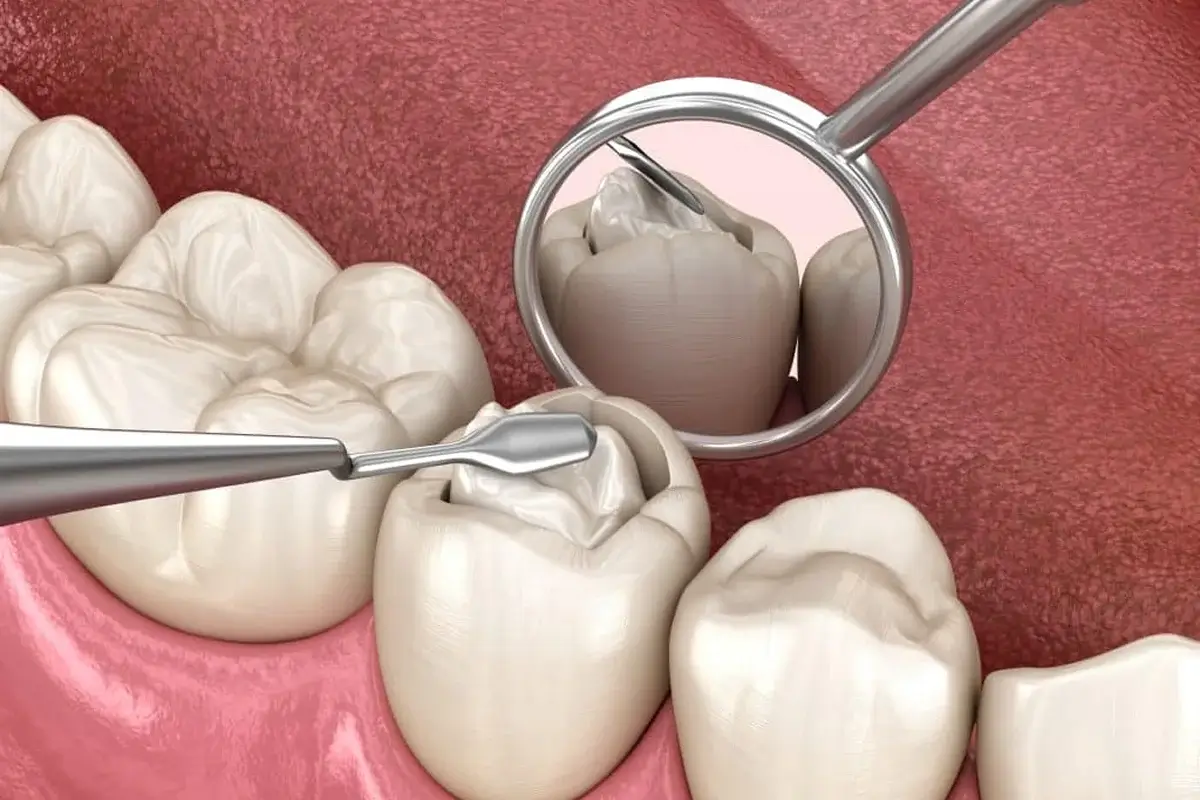 Dental Filling