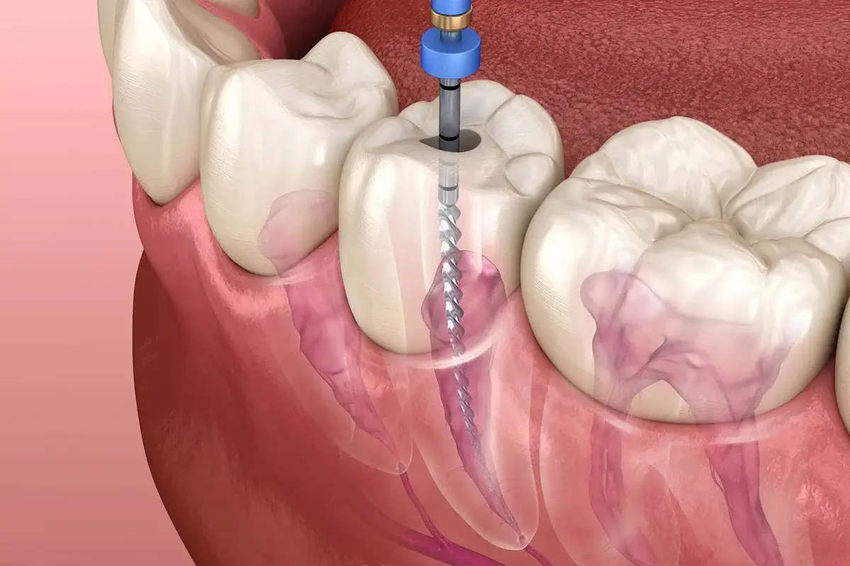 Root Canal