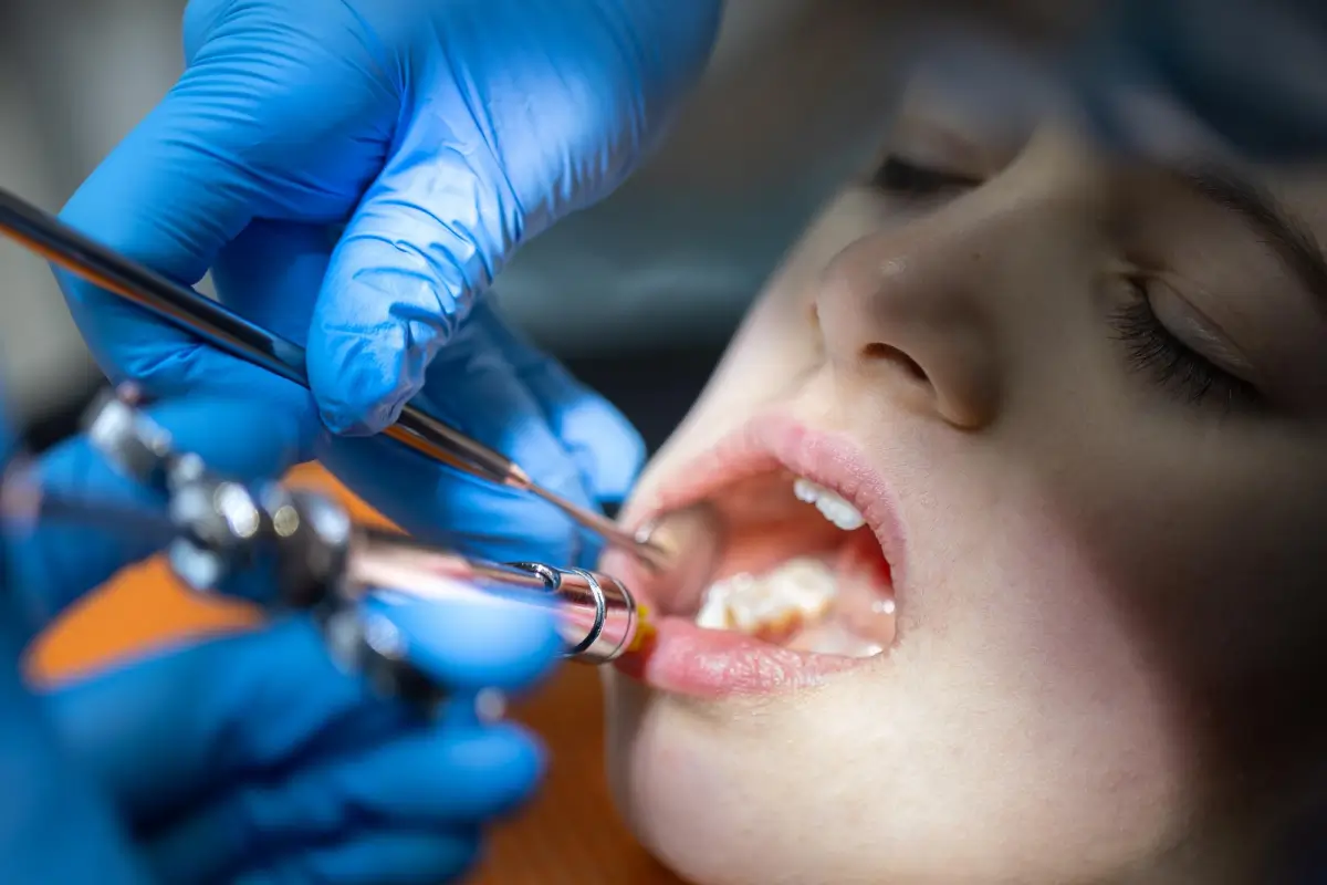 Dental Filling